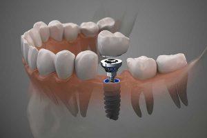 Dental Implant Innovations