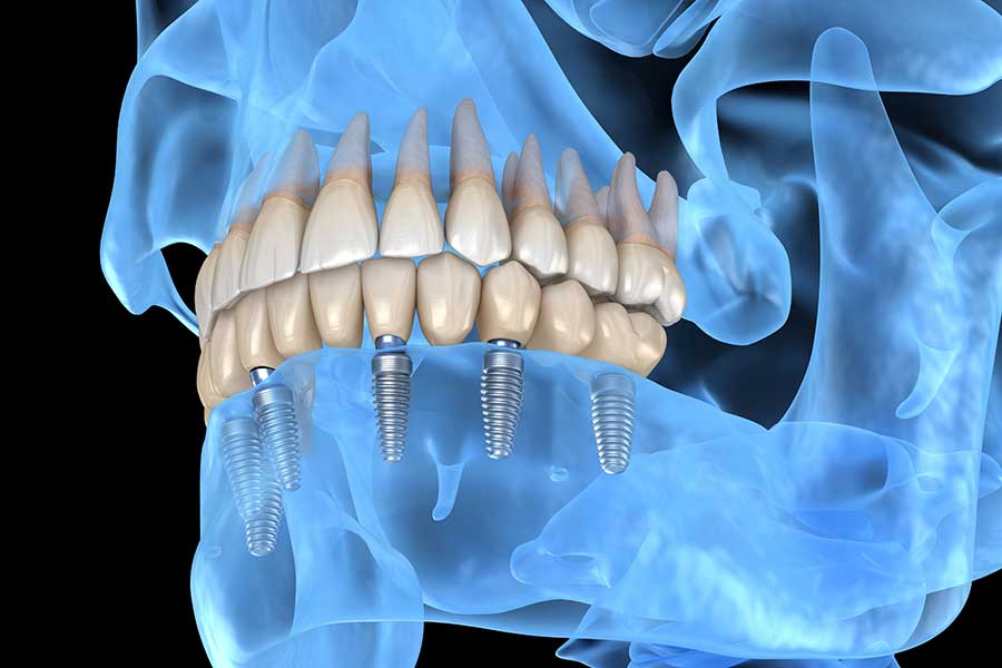 How Do Teeth and the Jaw Bone Work Together? » Ft. Worth Oral Surgeons ...