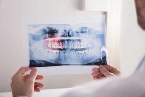 Decision on Wisdom Teeth