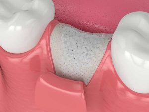 bone graft for dental implants