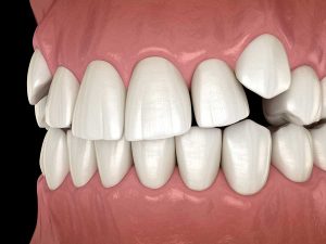 Resolving Impacted Canines
