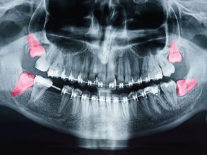 wisdom tooth removal