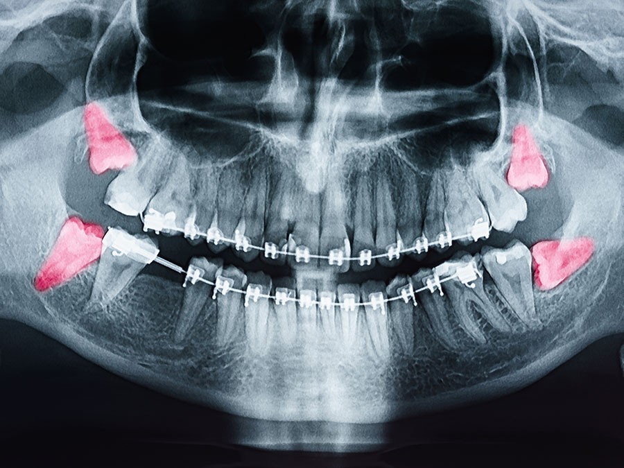 wisdom tooth removal