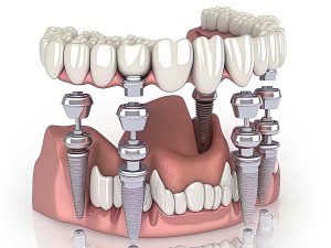 Dental-Implants-in-Fort-Worth-TX