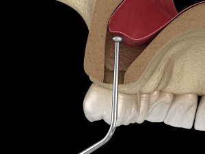 sinus lift for implants