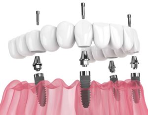 All-on-4 Dental Implants vs Traditional Dental Implants