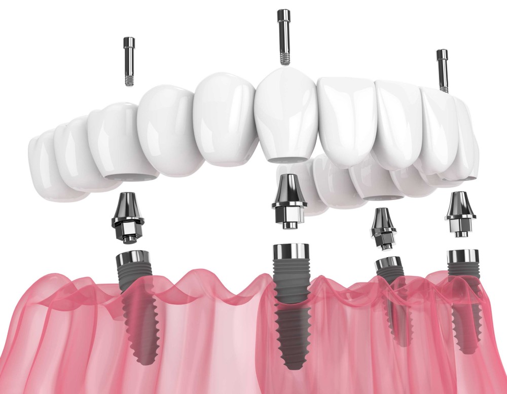 All-on-4 Dental Implants vs Traditional Dental Implants