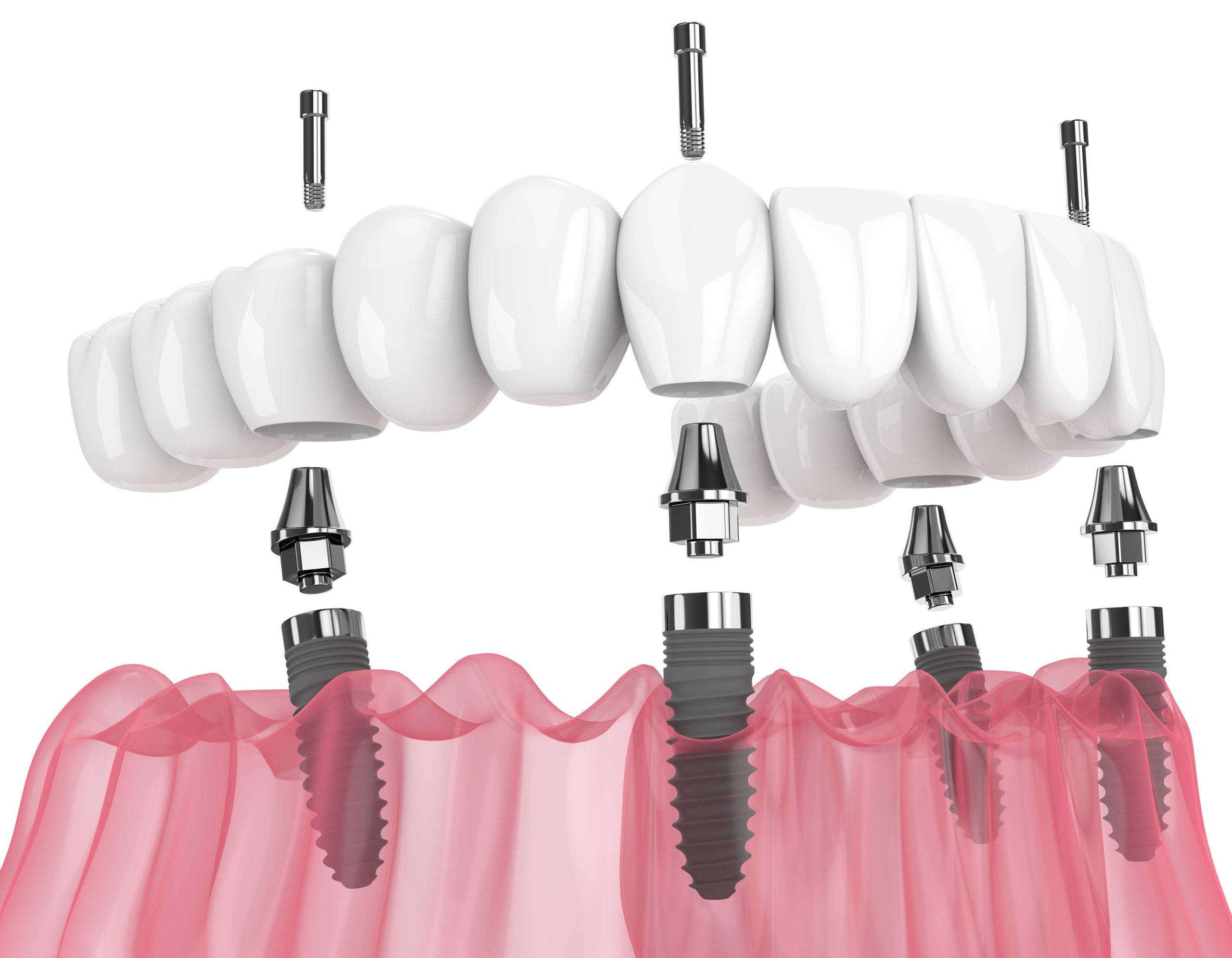 All-on-4 Dental Implants vs Traditional Dental Implants