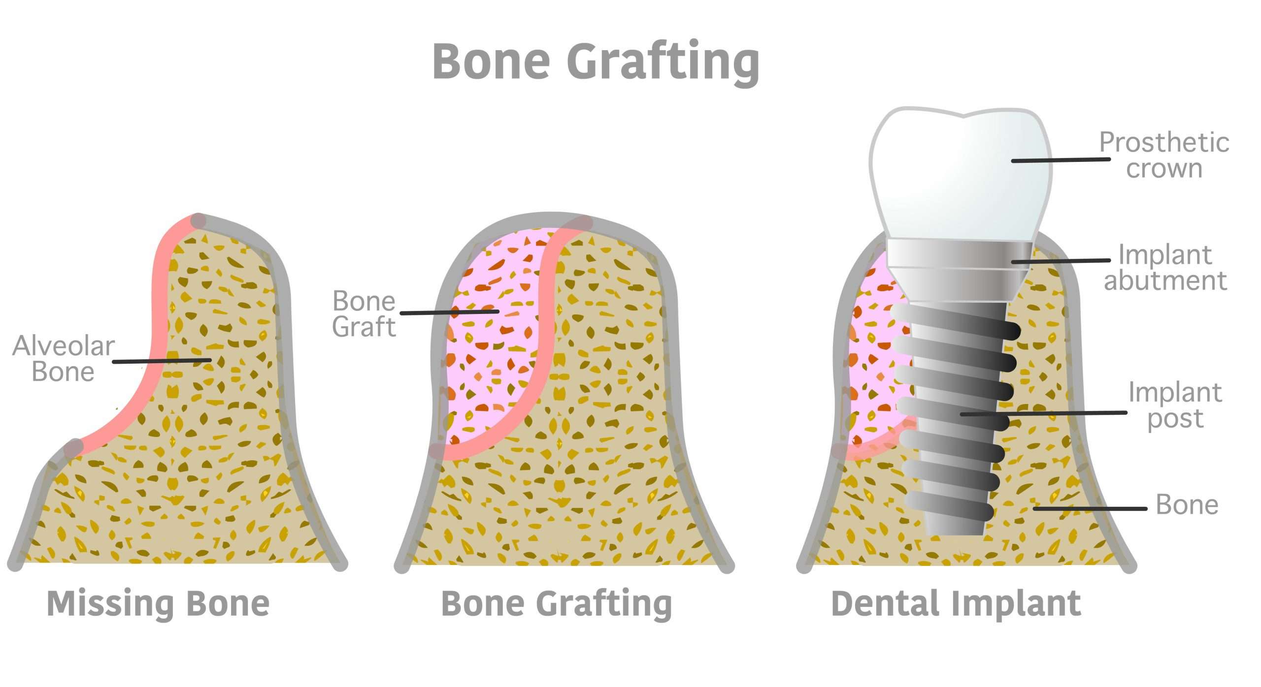 Bone-Grafting-Fort-Worth