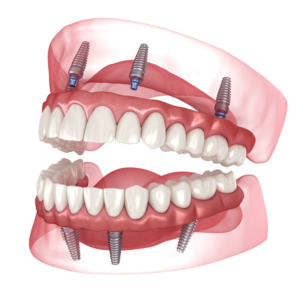 all-on-4-dental-implants-in-fort-worth
