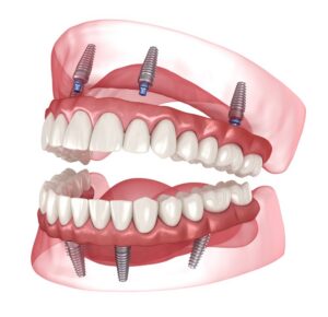 all on 4 dental implants in fort worth