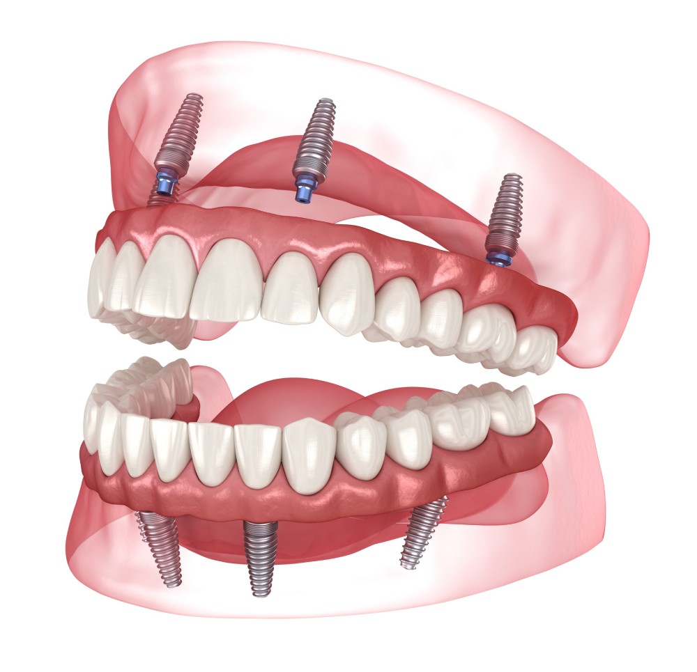 all on 4 dental implants in fort worth