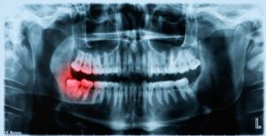 wisdom tooth jaw pain