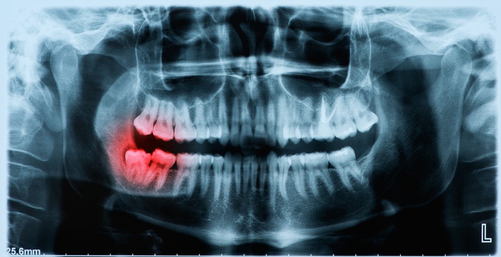 wisdom tooth jaw pain