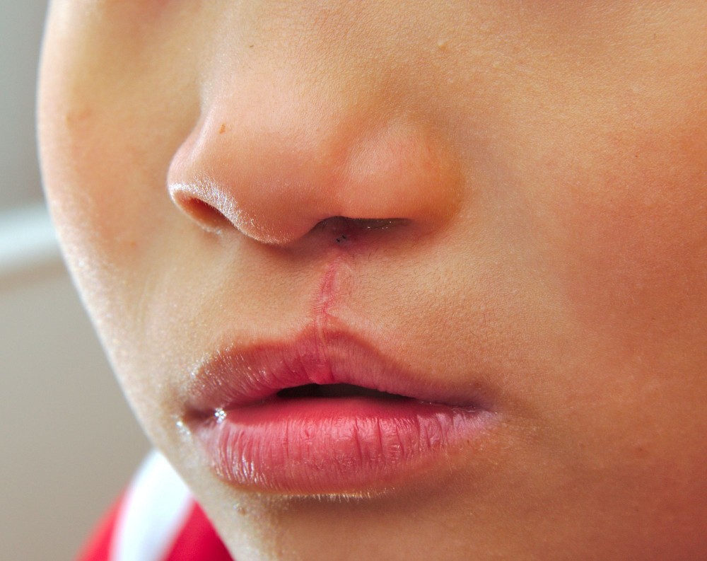 cleft lip oral surgeon