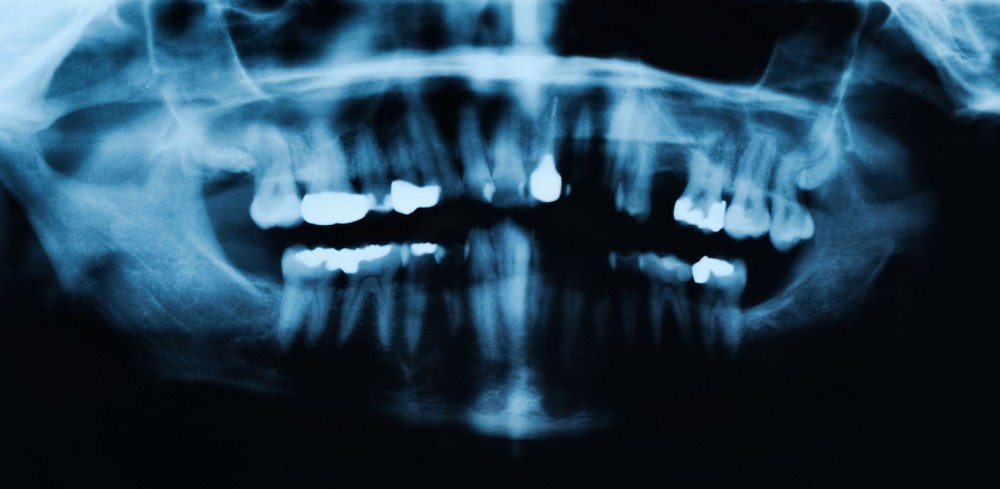 impacted wisdom teeth